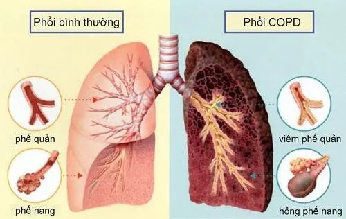 Nguyên nhân gây bệnh phổi tắc nghẽn mãn tính (COPD)