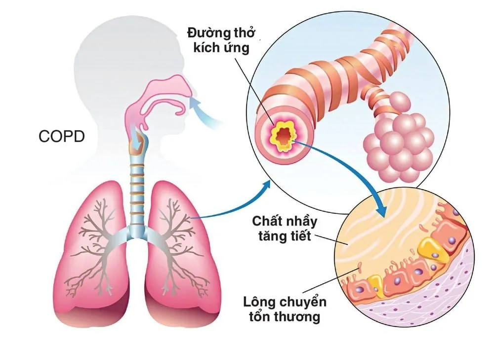 Hút thuốc lá