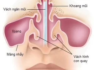 Bệnh viêm mũi vận mạch