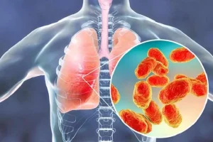 Bệnh viêm phổi là gì