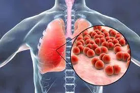 Các loại viêm phổi thường gặp