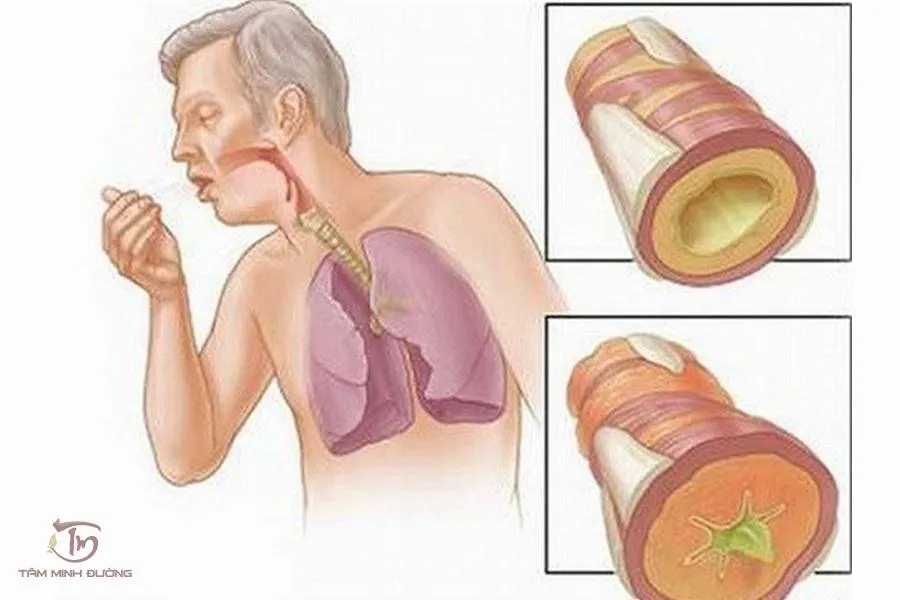 Nguyên nhân gây ho có đờm lâu ngày