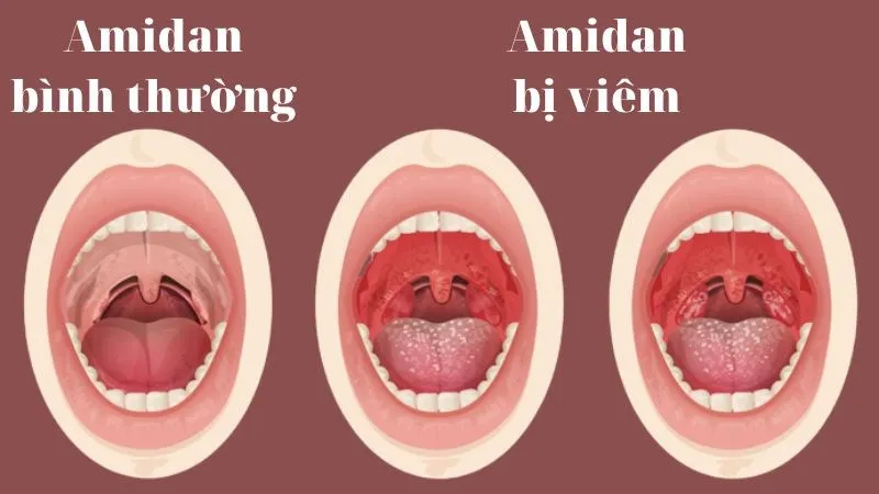 Viêm amidan là gì?