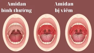 Cách chữa viêm amidan không cần kháng sinh
