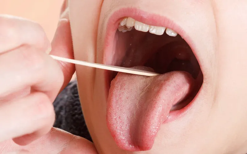 Các cách chữa viêm amidan không cần kháng sinh hiệu quả tại nhà