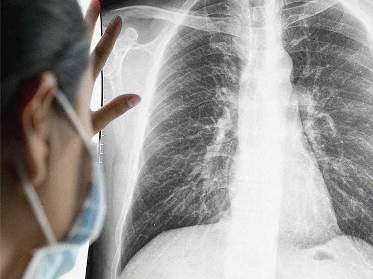 Tại sao ung thư phổi giai đoạn đầu khó phát hiện?