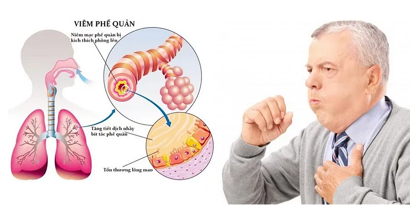 Đau ngực khi ho là dấu hiệu gì? Tổng quan về triệu chứng này