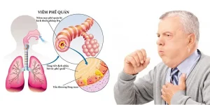 Đau ngực khi ho là dấu hiệu gì
