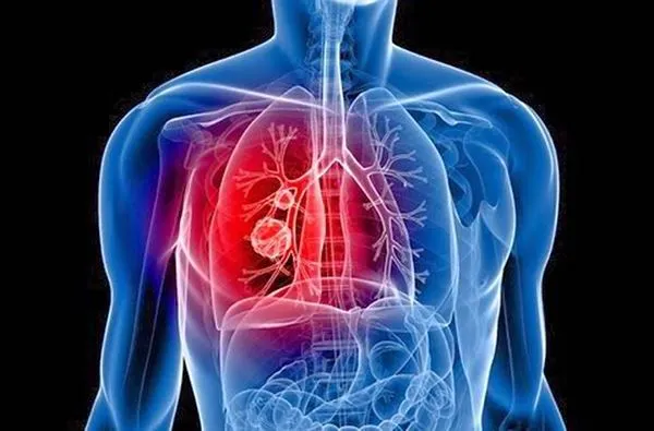 Các nguyên nhân phổ biến gây đau ngực khi ho