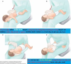 Dị vật đường thở và cách sơ cứu