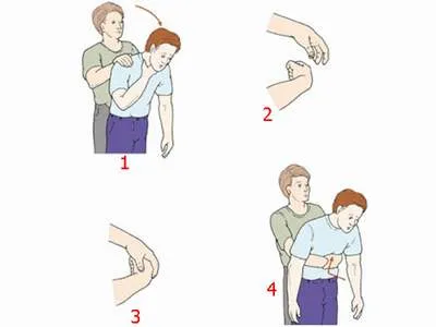 Dấu hiệu nhận biết dị vật đường thở khẩn cấp