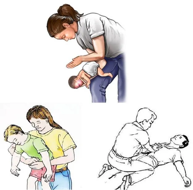 Cách sơ cứu dị vật đường thở khẩn cấp