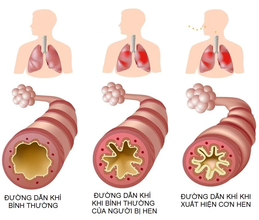 Hen phế quản là gì?