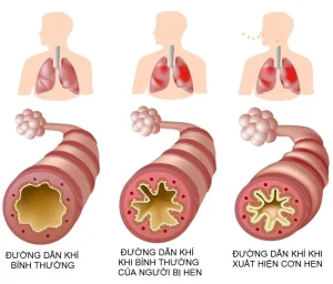 Hen phế quản là gì