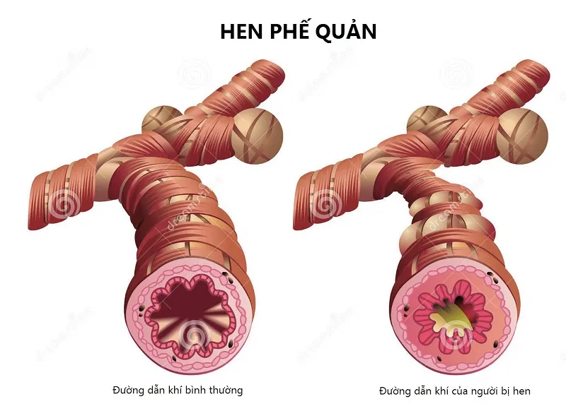 Nguyên nhân gây hen phế quản