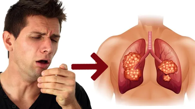 Ho khan kéo dài là bệnh gì? Các nguyên nhân tiềm ẩn bạn cần biết