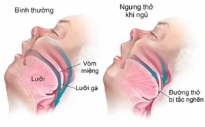 Hội chứng ngưng thở khi ngủ