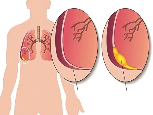 Phổi có nước là gì?