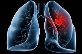 Phổi có nước là bệnh gì? Các nguyên nhân gây tràn dịch màng phổi và phù phổi