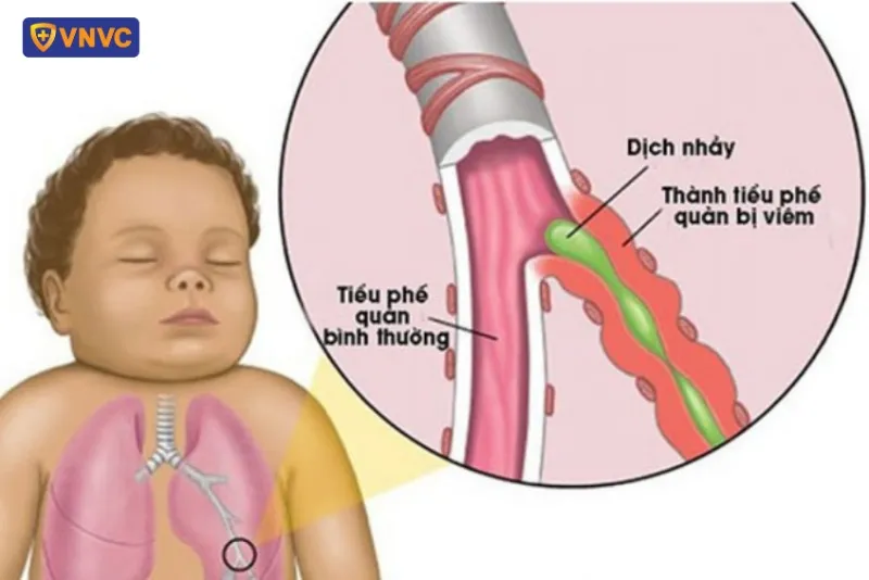 Viêm tiểu phế quản là gì?