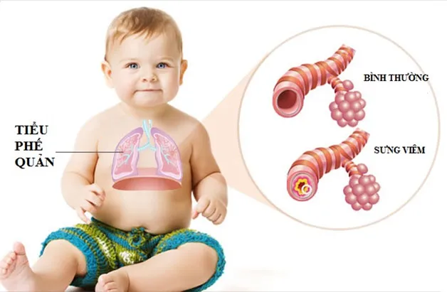 Trẻ bị viêm tiểu phế quản phải làm sao? Nhận biết sớm triệu chứng để điều trị kịp thời