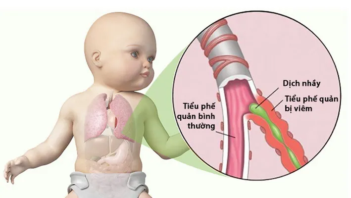 Giai đoạn đầu (thường 1-2 ngày đầu): Giống cảm lạnh thông thường
