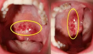 Viêm họng mãn tính có nguy hiểm không