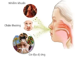 Viêm mũi dị ứng và cách điều trị