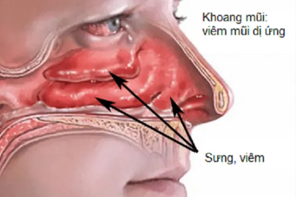 Nguyên nhân gây viêm mũi dị ứng
