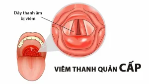 Viêm thanh quản cấp là gì