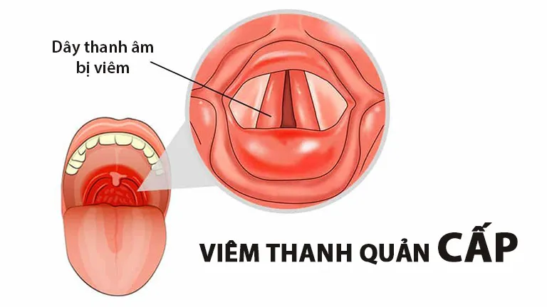 Viêm thanh quản cấp là gì