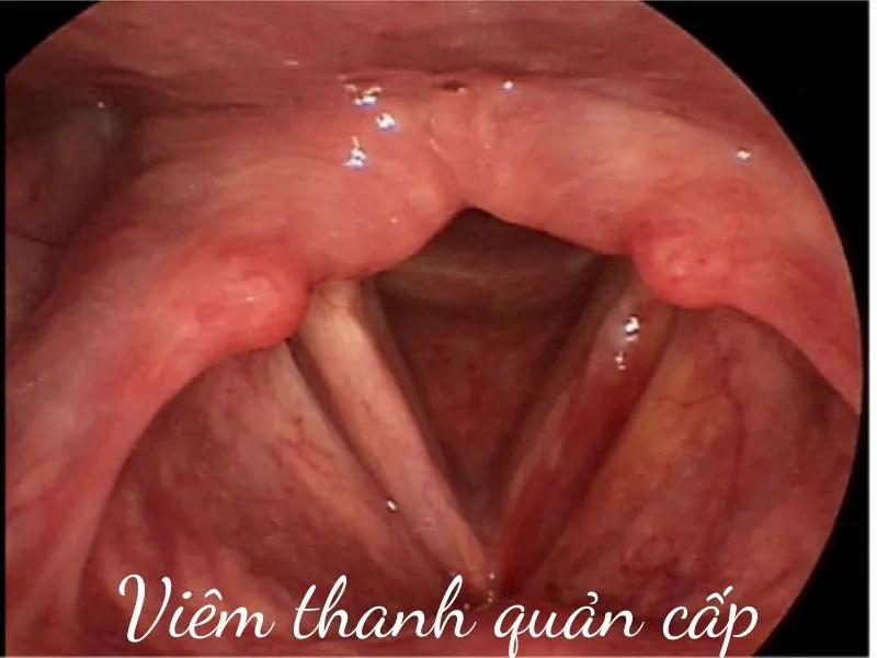 Viêm thanh quản cấp là gì?