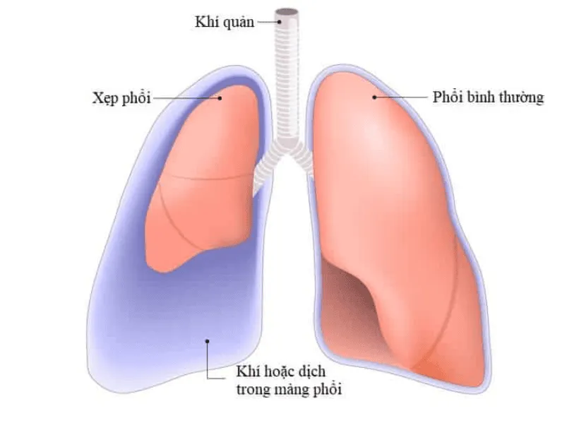 Các loại xẹp phổi và nguyên nhân gây bệnh