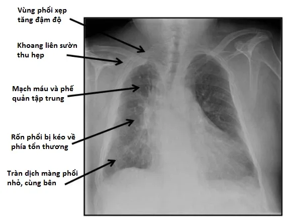 Xẹp phổi do tắc nghẽn (Obstructive Atelectasis)